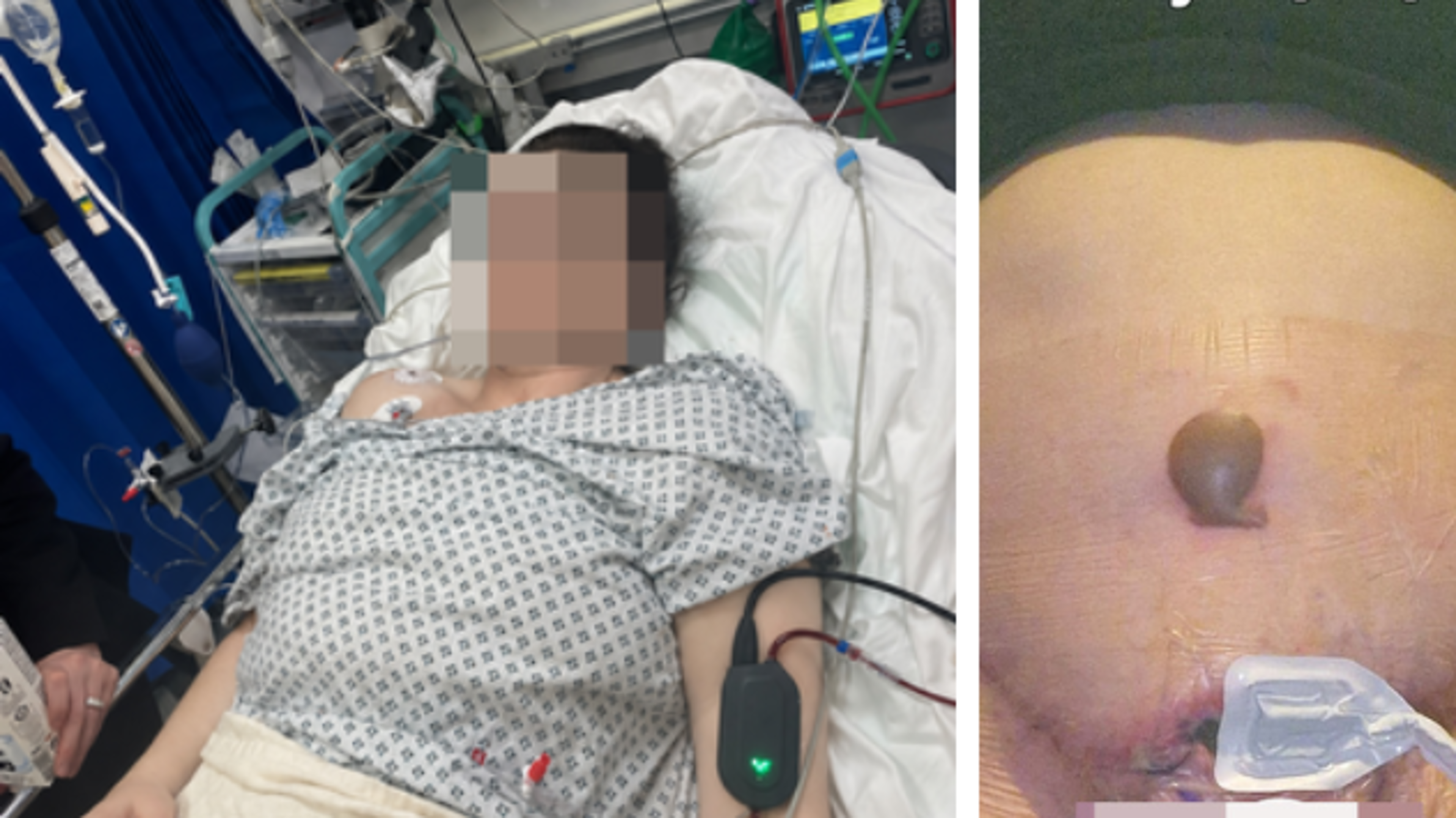 Mum’s tummy tuck horror at Irish clinic left her looking like she was ‘attacked by a shark’