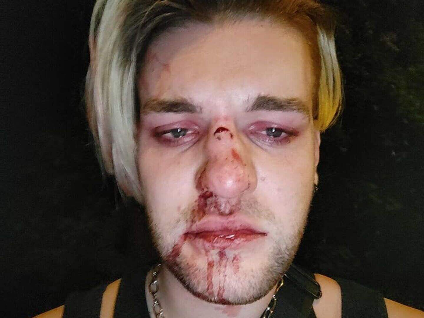 Young Dublin Bus victim of horror homophobic attack says he is ‘healing ...