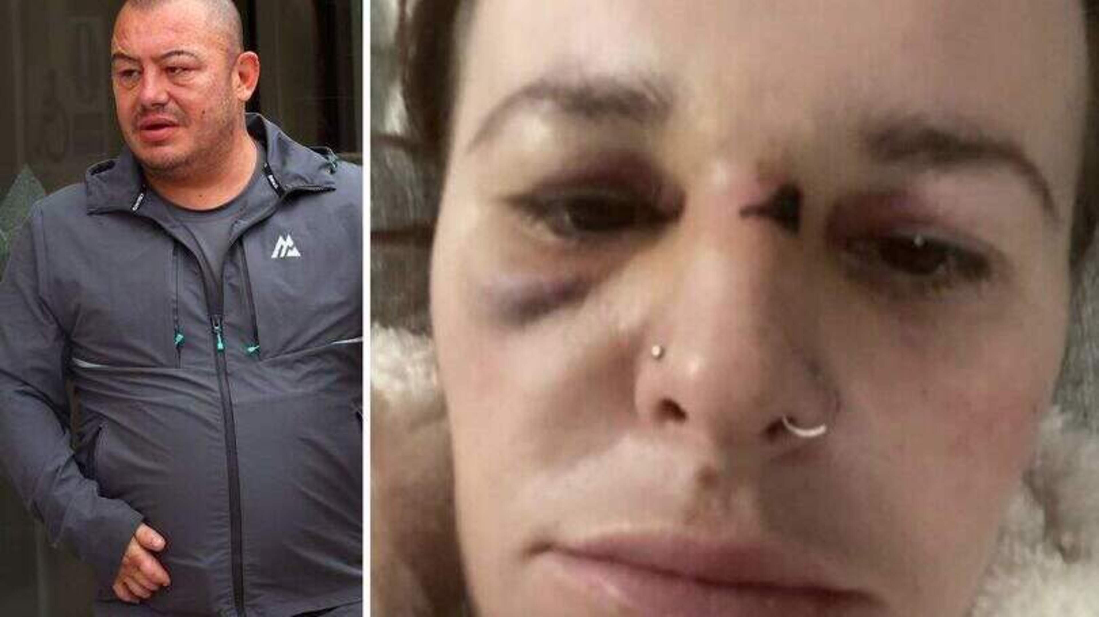 ‘My ex tortured me for months’: Alleged abuse victim shares horrific injuries after husband charged