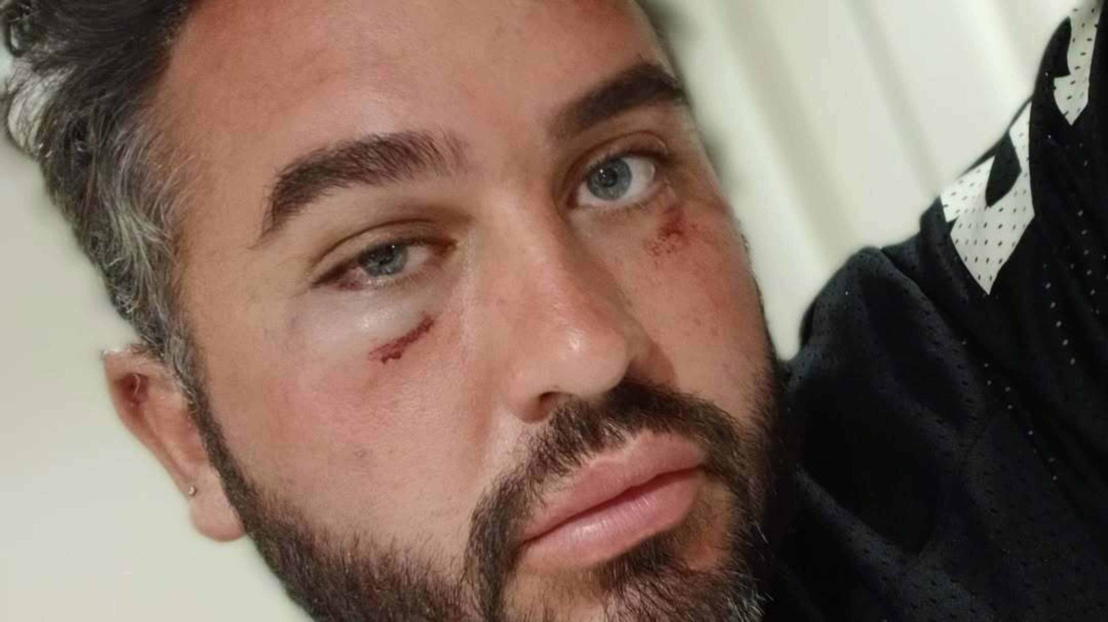 Hughie Maughan says people who left him battered and bruised in attack are ‘scum bags’